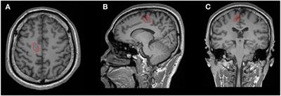 Small Lesion Size Is Associated with Sleep-Related Epilepsy in Focal Cortical Dysplasia Type II